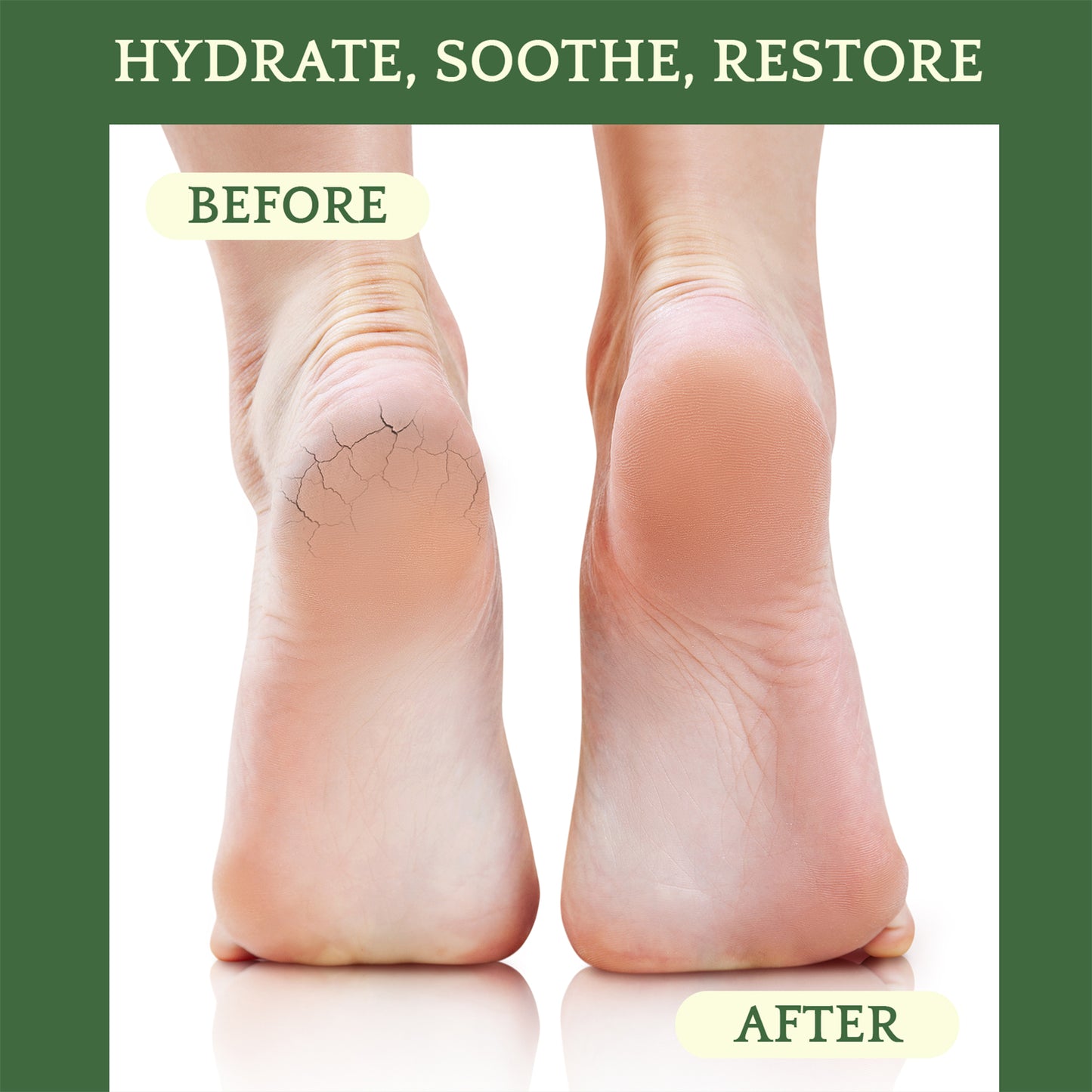Water-Free Cracked Heels Repair Balm – Dry Skin Treatment – 100% Natural Ingredients